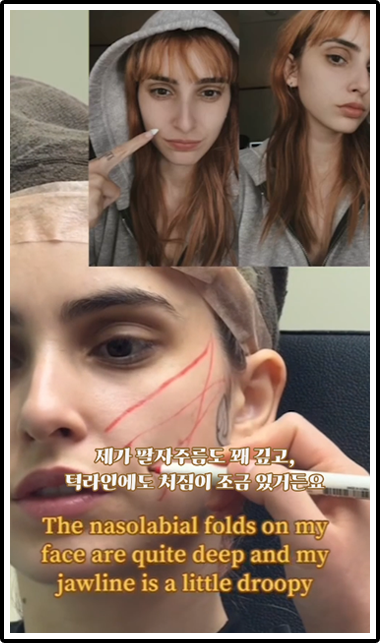 제가 팔자주름도 꽤 깊고, 턱라인에도 처짐이 조금 있거든요