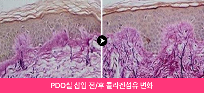 PDO실 삽입 전/후 콜라겐섬유 변화