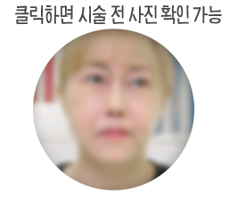 실리프팅 한 쪽은 10살 어려보인대요