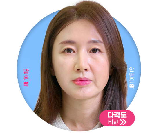 역시 실리프팅 특화병원은 다르구나